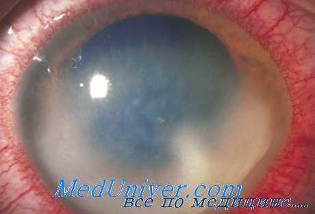 лечение эндофтальмита