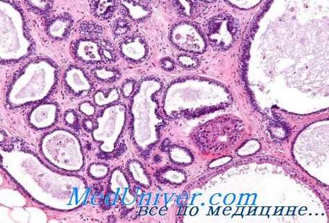 атипичная гиперплазия эндометрия