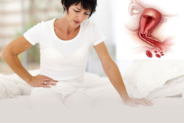 Ановуляторное маточное кровотечение