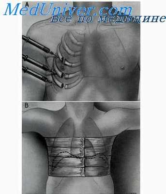 кавернотомия