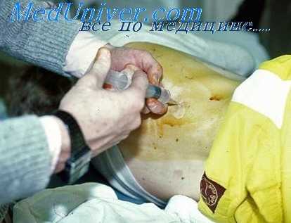 кавернотомия