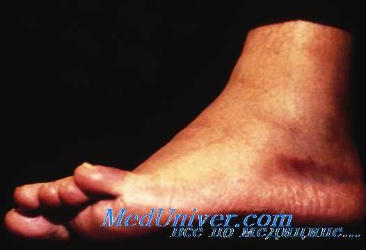 артроз голеностопного сустава