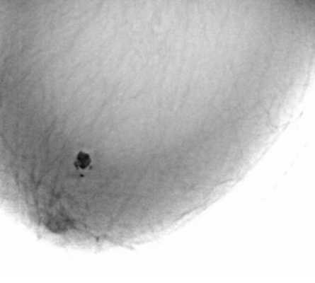 трансплантат из сухожилия нежной мышцы