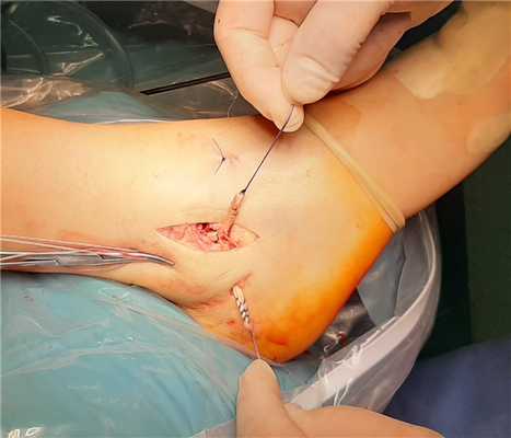 пластика передней таранно-малоберцовой и пяточно-малоберцовой связок голеностопного сустава аутосухожилием из нежной мышцы