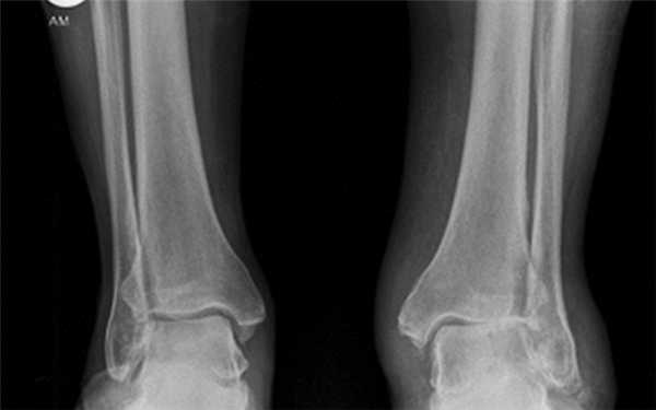 Остеоартроз голеностопного сустава