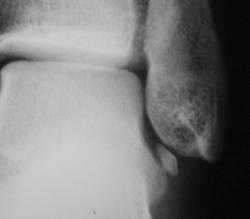 восстановление связок голеностопа при помощи аутосухожилия