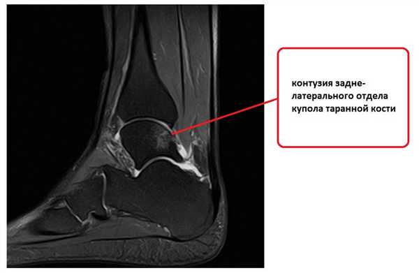 контузия таранной кости