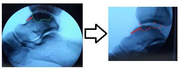 тест переднего выдвижного ящика голеностопа