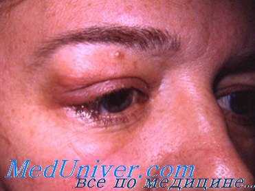 опухоль слезной железы