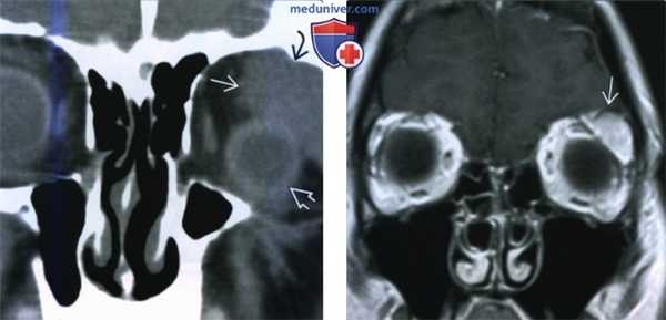 Доброкачественная смешанная опухоль слезной железы - лучевая диагностика