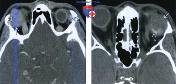 Доброкачественная смешанная опухоль слезной железы - лучевая диагностика