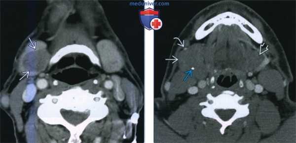 Доброкачественная смешанная опухоль поднижнечелюстной железы - лучевая диагностика