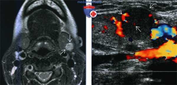 Доброкачественная смешанная опухоль поднижнечелюстной железы - лучевая диагностика