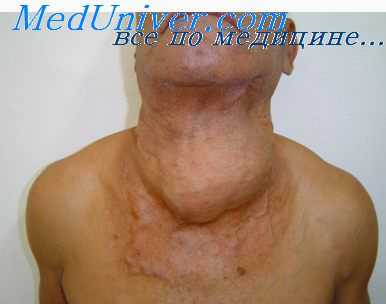 опухоли щитовидной железы