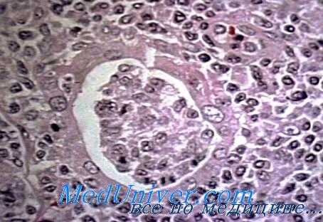 образования щитовидной железы