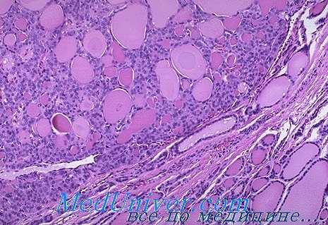 аденома щитовидной железы