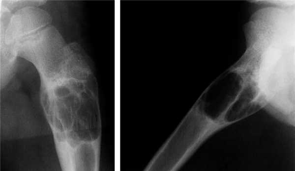 Киста кости