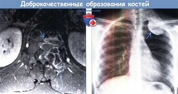 Редкие доброкачественные образования костей грудной клетки на МРТ, рентгенограмме
