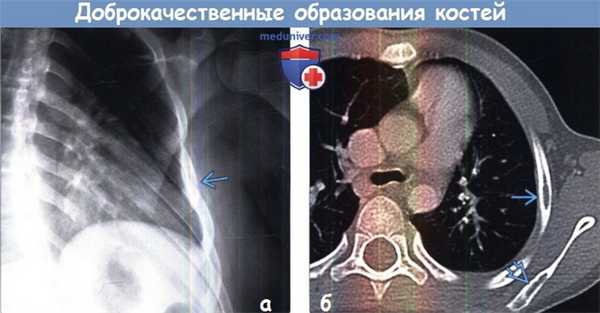 Редкие доброкачественные образования костей грудной клетки на КТ