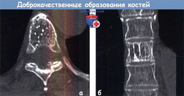 Редкие доброкачественные образования костей грудной клетки на КТ
