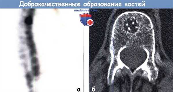 Редкие доброкачественные образования костей грудной клетки на КТ