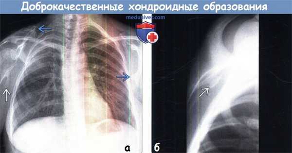 Доброкачественные хондроидные образования грудной стенки на рентгенограмме