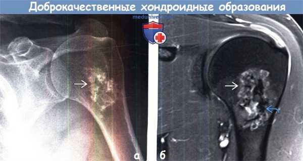 Доброкачественные хондроидные образования грудной стенки на рентгенограмме, МРТ