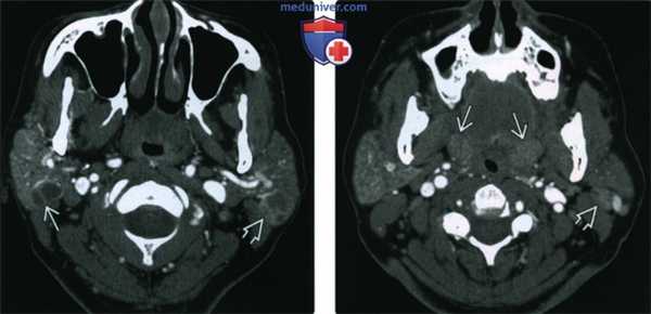 КТ, МРТ, УЗИ лимфоэпителиального поражения околоушной железы при ВИЧ