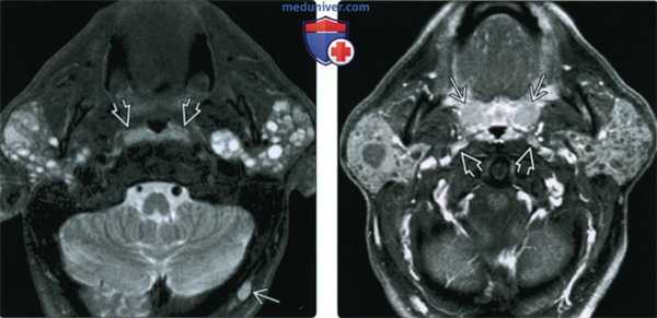 КТ, МРТ, УЗИ лимфоэпителиального поражения околоушной железы при ВИЧ