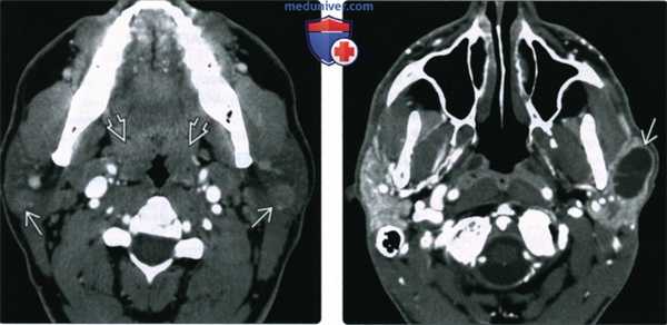 КТ, МРТ, УЗИ лимфоэпителиального поражения околоушной железы при ВИЧ