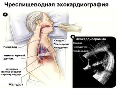 Чреспищеводная эхокардиография