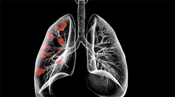 Ателектаз легкого