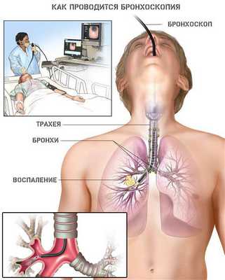 бронхоскопия