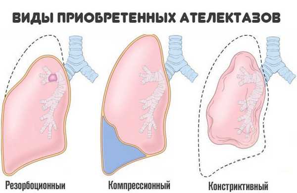 виды-ателектаза-легкого