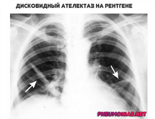 дисковидный-ателектаз-на-рентгене