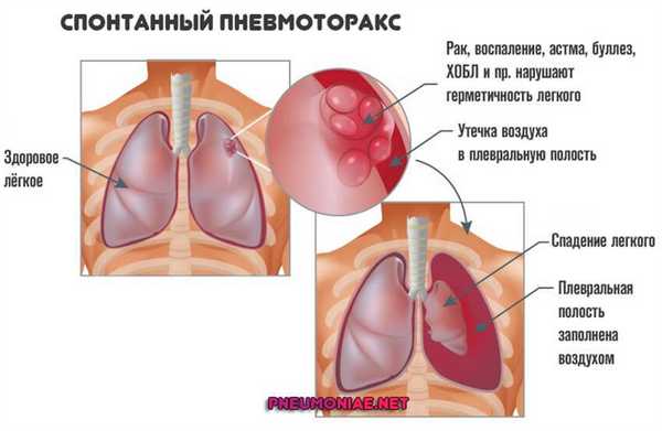 спонтанный-пневмоторакс