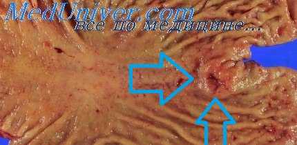 диагностика рака желудка