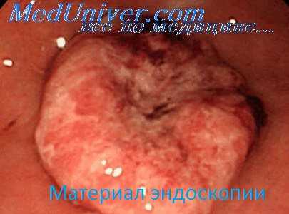 множественный рак желудка