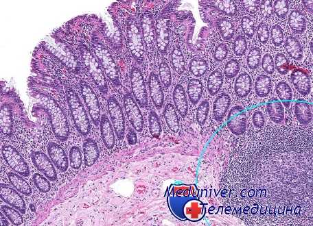 множественный рак желудка
