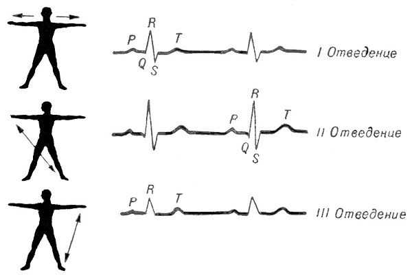 Стандартные отведения ЭКГ