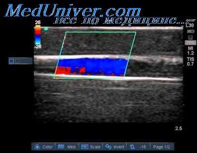 интракраниальные сосуды