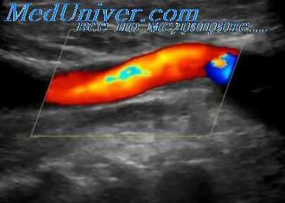 узи брахиоцефальных артерий