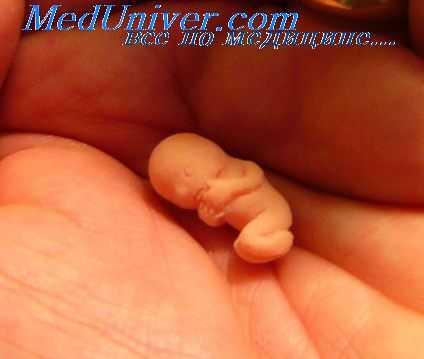 разрыв плодных оболочек