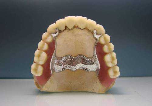 Бюгельные протезы