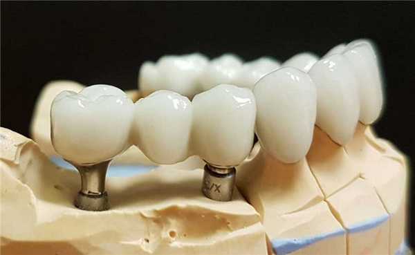 Консольный протез