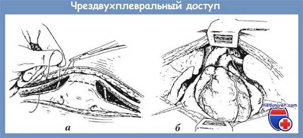 чрездвухплервальный доступ