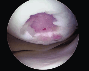 Локальное травматическое повреждение коленного сустава, вид через артроскоп.