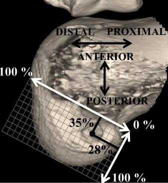 Рис. 6. Центр бедренного туннеля на 3D реконструкции наружного мыщелка бедренной кости: оптимальное положение центра бедренного туннеля.