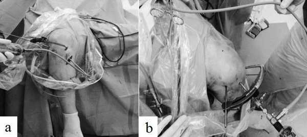 Рис. 5 (a, b). Модифицированная техника установки внутрисуставного наконечника бедренного направителя через стандартный медиальный порт.
