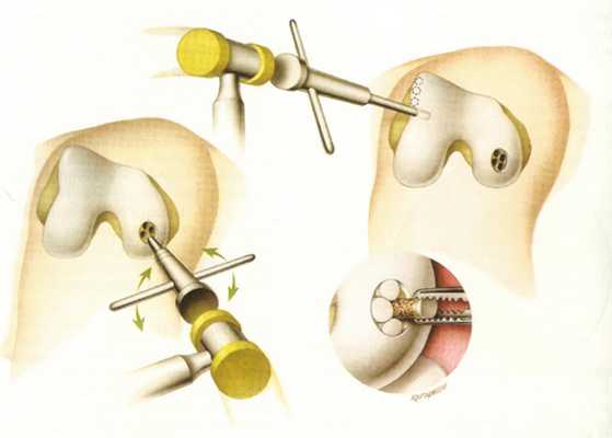 артроскопия при повреждении хряща